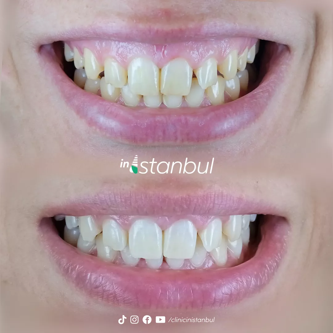 Teeth Whitening Before & After 2