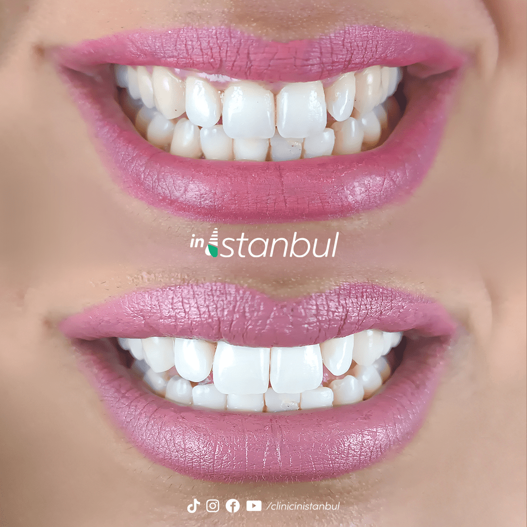 teeth1-post-instagram-dental-clinic-inistanbul-2