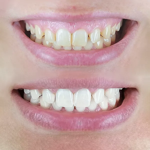 french-teeth-whitening-1