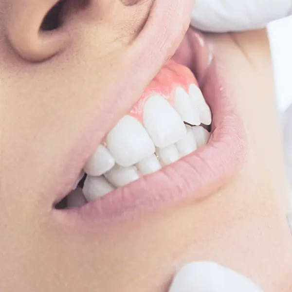 Traitement parodontal
