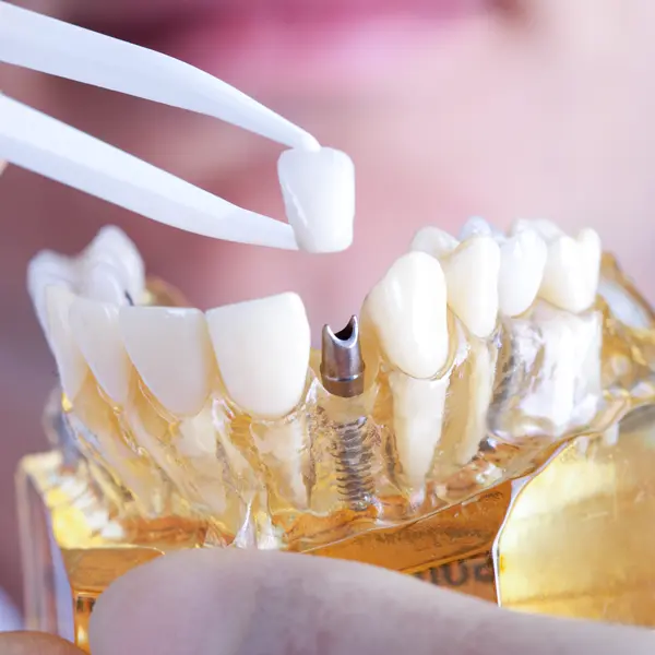 Teeth Implants Turkey Price